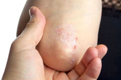 Pediatric Psoriasis: Emerging Oral Options
