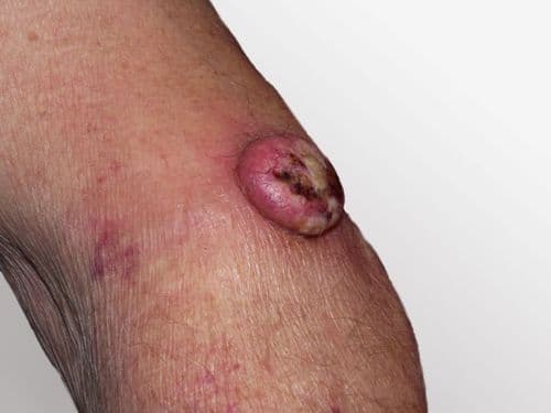 'HowTo’ Choose: PD-1 and PD-L1 Inhibitors in Advanced Cutaneous Squamous Cell Carcinoma 